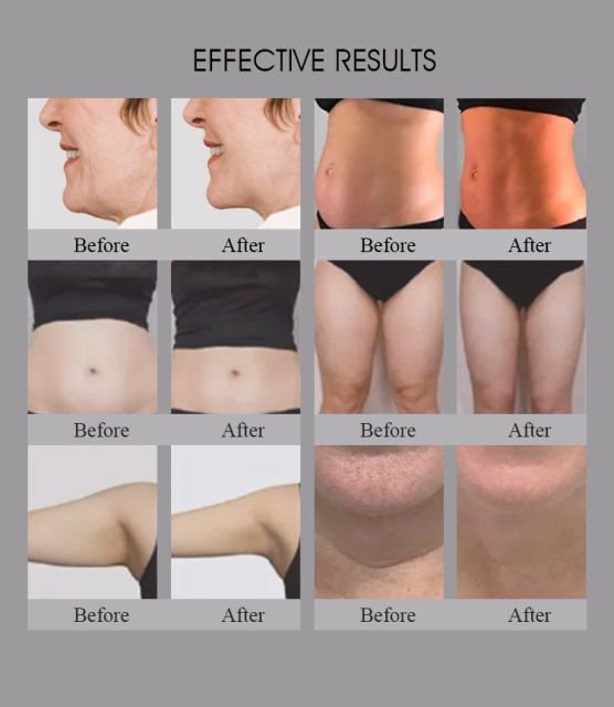 3 in 1 Salon Use Trusculpt Id Flex Rf Body Contouring Body Sculpting 2mhz Cellulite Treatment Fat Reduction Trufat Machine