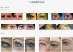 Beauty Plasma Pen Eye Lift Machine Jet plasma Lift For Skin Treatment Acne Machine