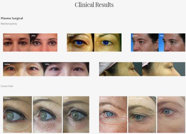 Beauty Plasma Pen Eye Lift Machine Jet plasma Lift For Skin Treatment Acne Machine