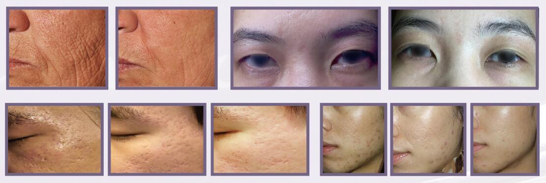 Plasma lifting machine plasma home beauty device
