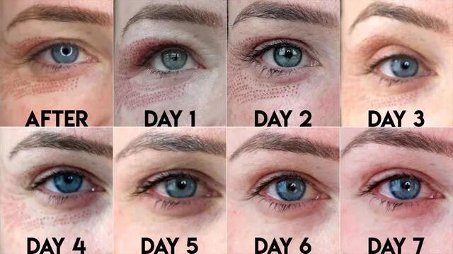 Plasma lifting machine plasma home beauty device