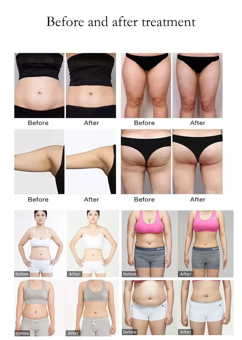 Professional Lymphatic Drainage Cellulite Reduction Roller Slimming Machine Massage Inner Ball Roller Weight Loss Machine