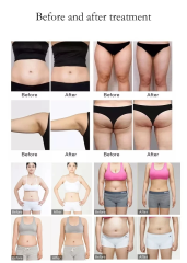 Professional Lymphatic Drainage Cellulite Reduction Roller Slimming Machine Massage Inner Ball Roller Weight Loss Machine