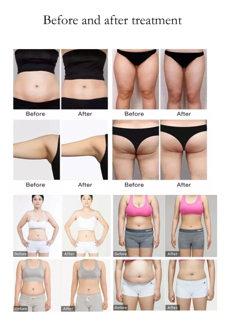 Professional Lymphatic Drainage Cellulite Reduction Roller Slimming Machine Massage Inner Ball Roller Weight Loss Machine