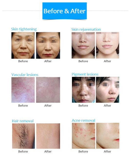 diode depilation machine DPL photon skin rejuvenation lifting anti-wrinkle and beauty machine