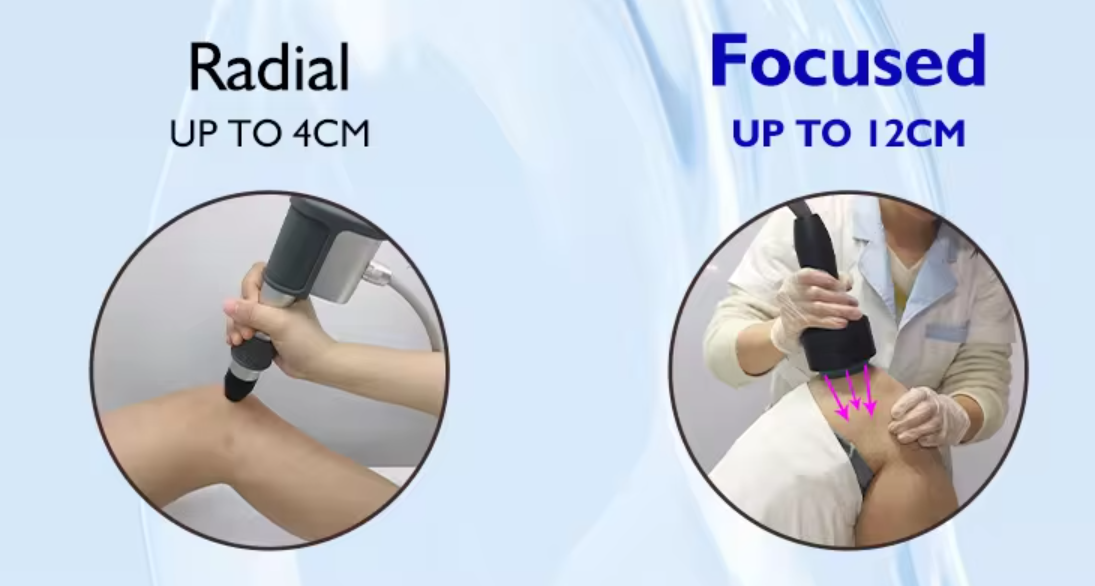 Radial vs Focused Shockwave