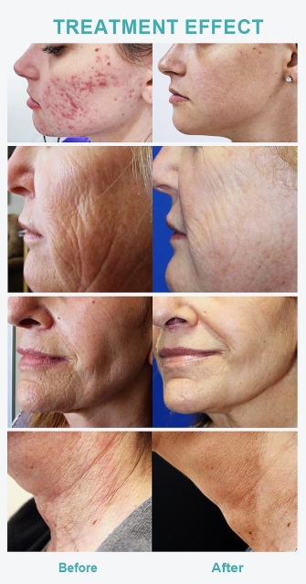 Professional Rf Microneedling Scarring Removal Skin Tightening Micro Needling Machine