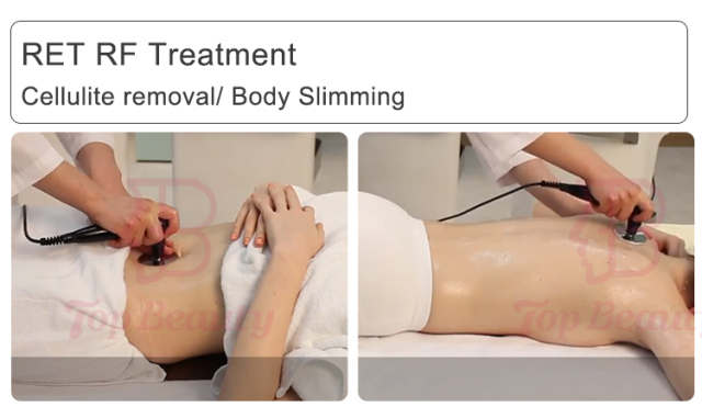 Tecar Therapy Diathermy Machine CET RET For Rehabilitator Sport Tecar Machine