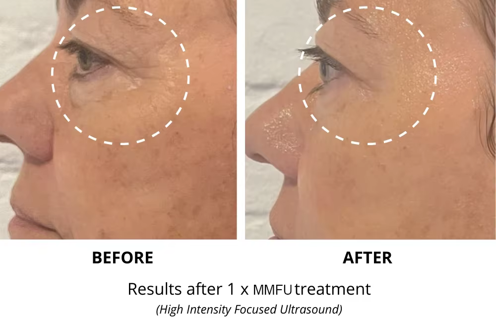 Real HIFU Before and After Results for Face