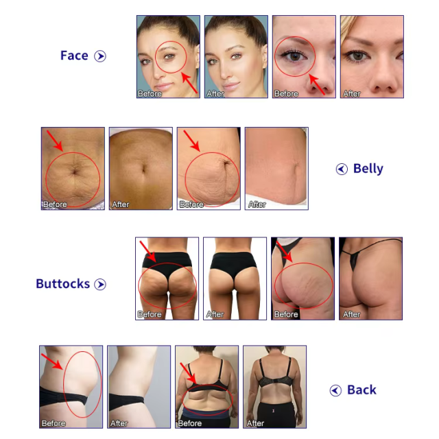 vacuum rf face lifting skin tighten RET CET RF massage Beauty machine