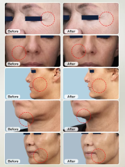 RF Micro-needle + Thermagia Fractional RF System Microneedling RF Fractional Radio Frequency Beauty Equipment