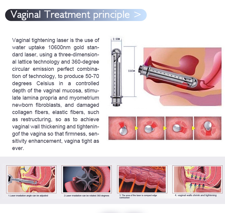 Fractional CO2 laser Vaginal Treatment principle