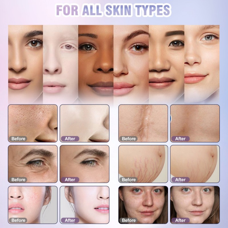 Before & After Fractional CO2 Laser Treatment