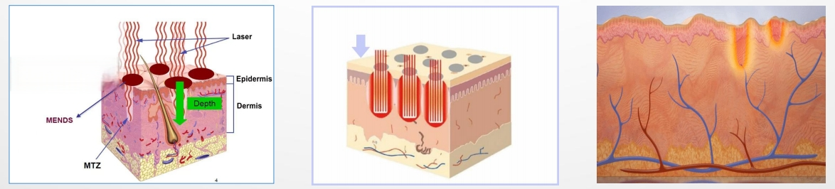 Fractional CO2 Laser Working Principle