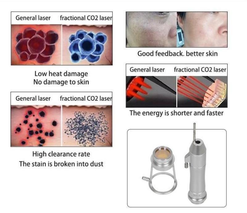 Fractional CO2 Laser VS General Laser