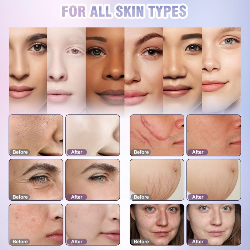 Before & After Fractional CO2 Laser Treatment