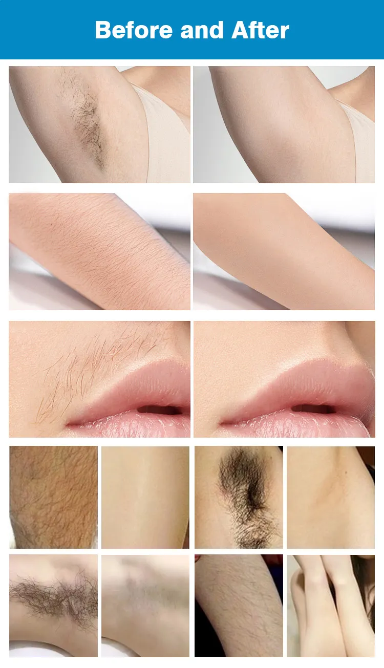 Results Before and After Alexandrite and Nd:YAG Laser Treatment