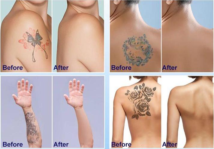 Before and after picos laser tattoo removal treatment