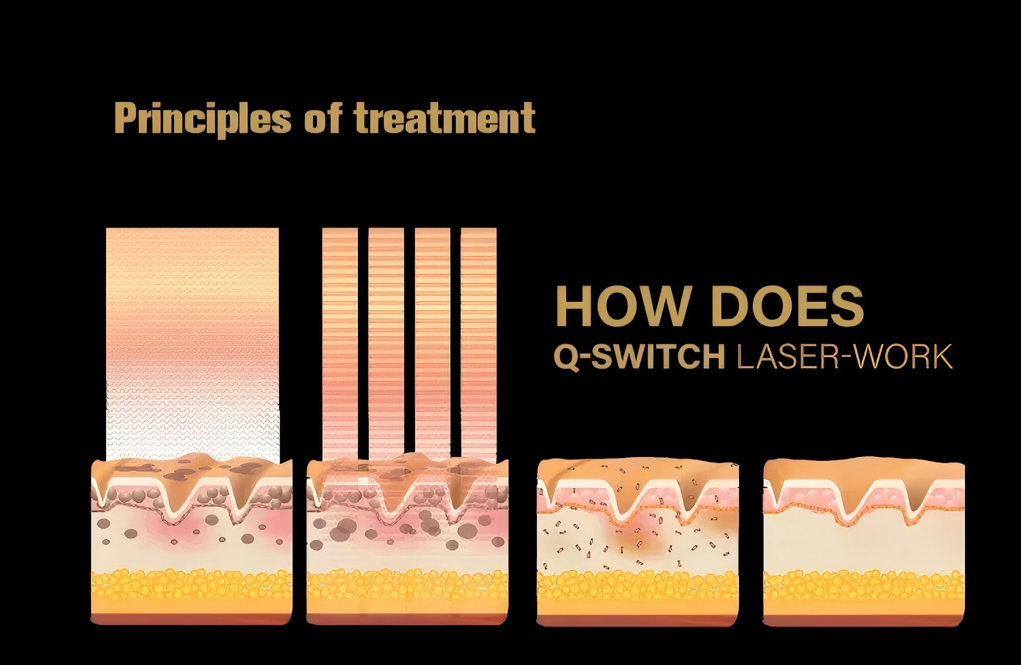 How does Q-Switched Nd:YAG laser work