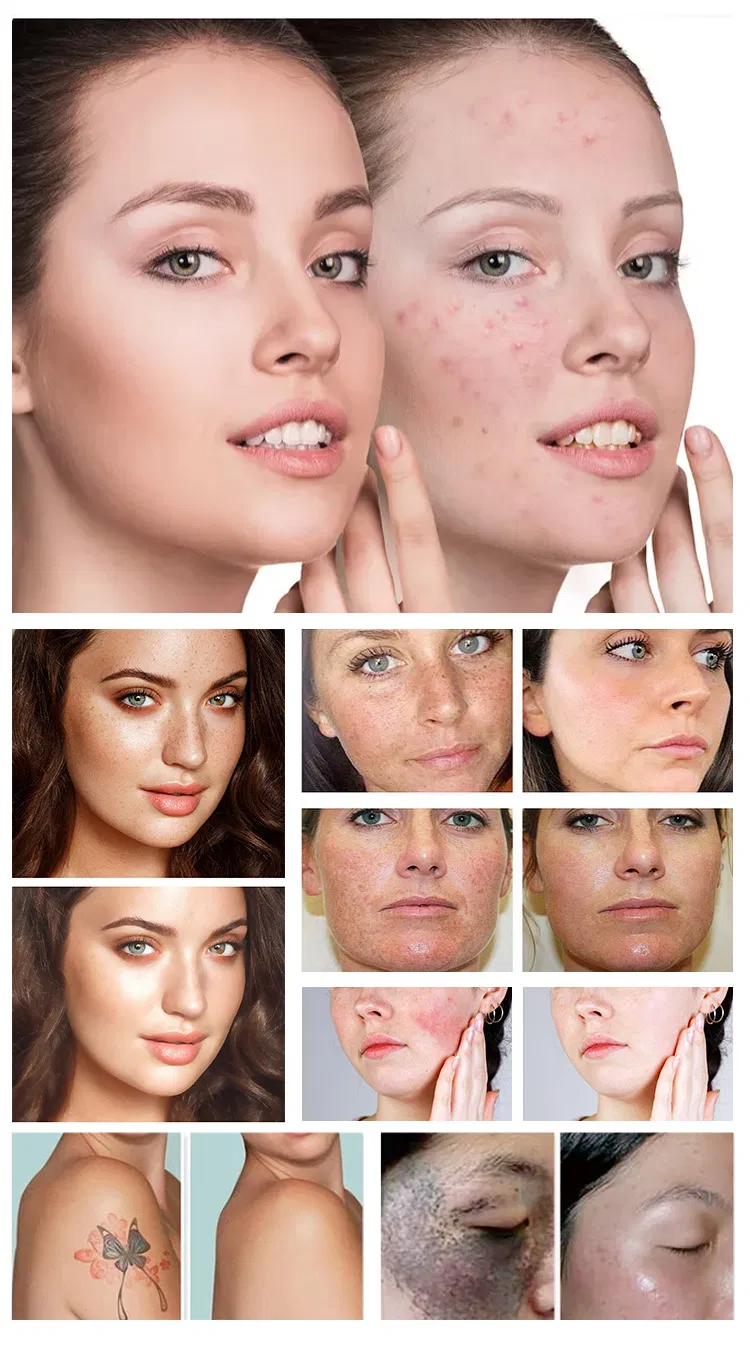 Results Before and After Alexandrite and Nd:YAG Laser Treatment