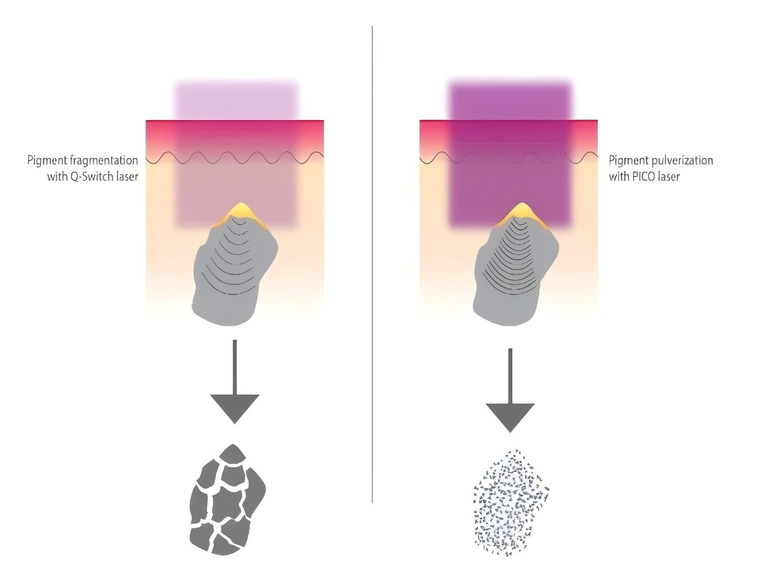 Picosecond Laser and Q-Switched Nd: Yag Laser Comparison