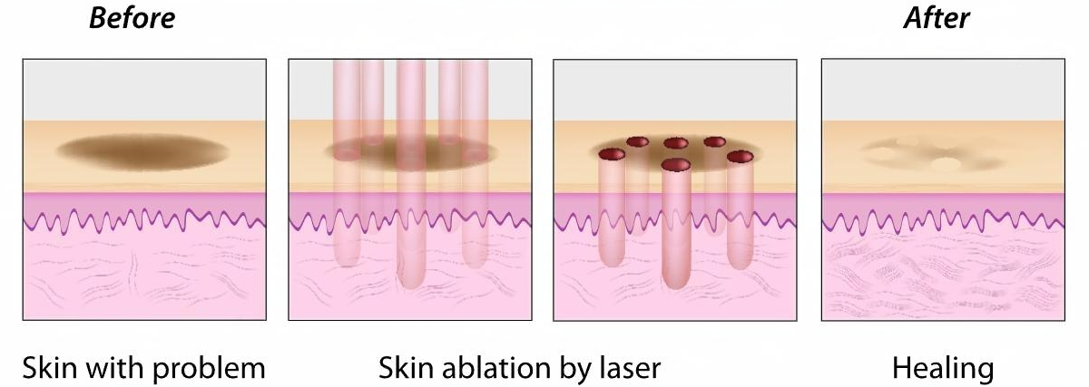 Fractional CO2 Laser Working Principle