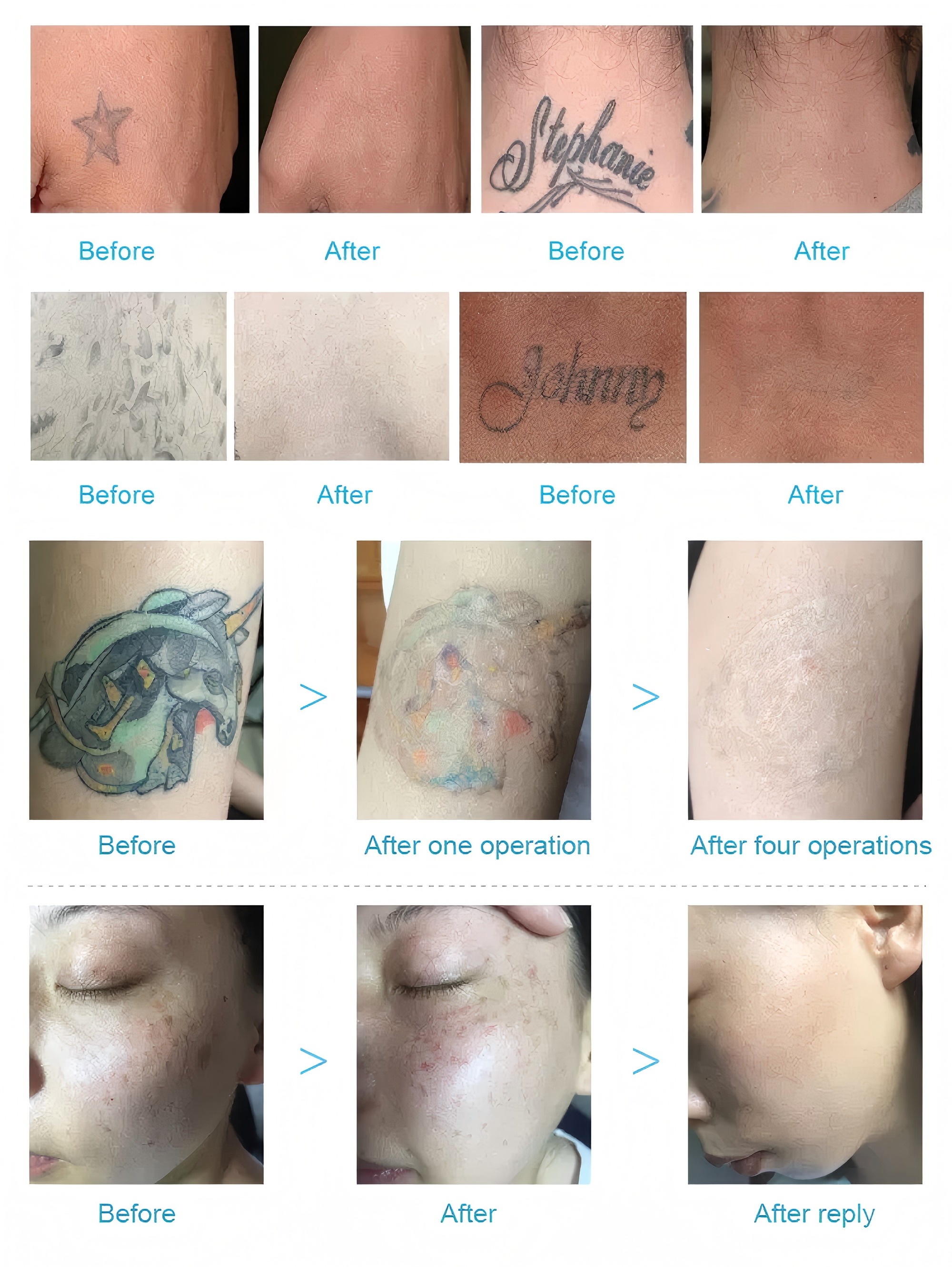 Before and after Pico laser treatment