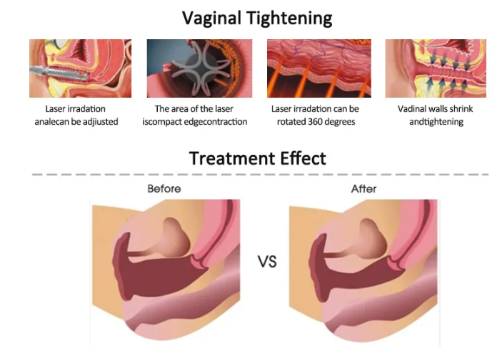 Fractional CO2 Laser Vaginal Treatment Principle