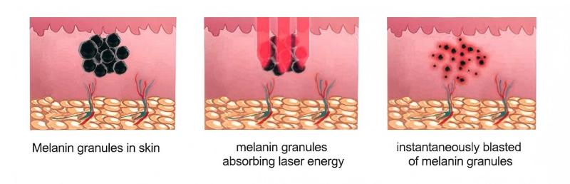 Pico Laser Work Principle