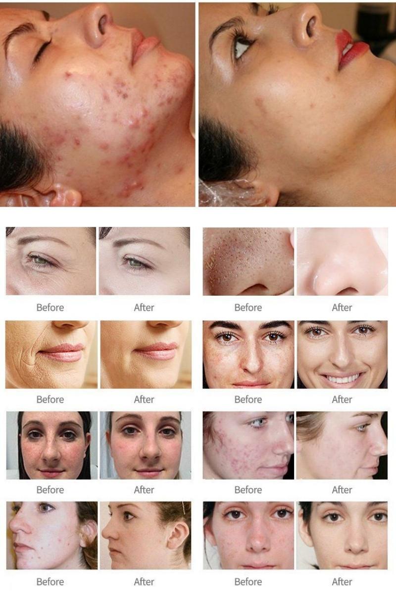 Before & After Fractional CO2 Laser Treatment:
