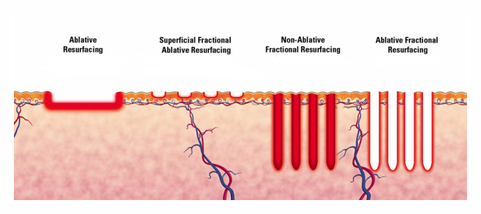 What is Fractional CO2 Laser