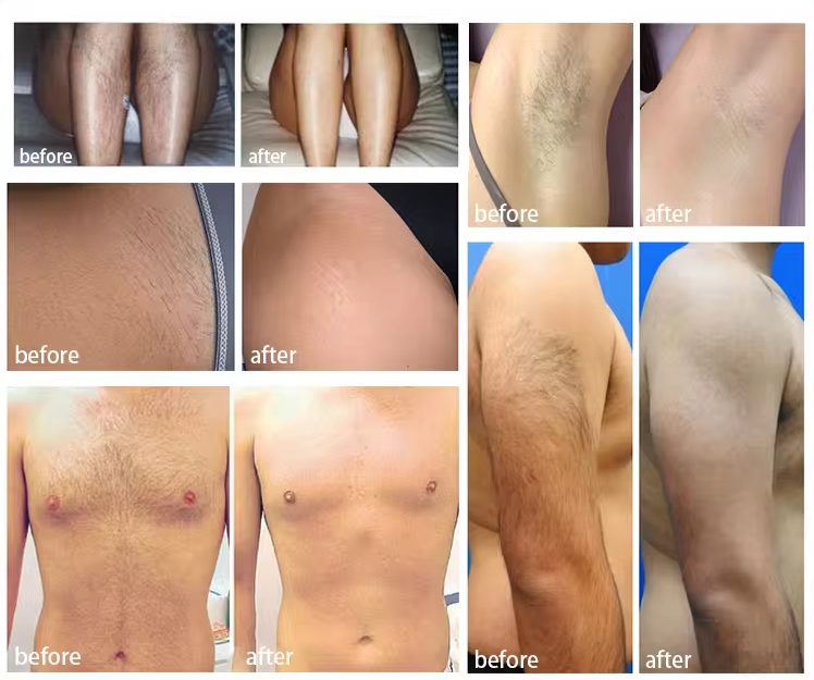 Before and after diode laser hair removal treatment