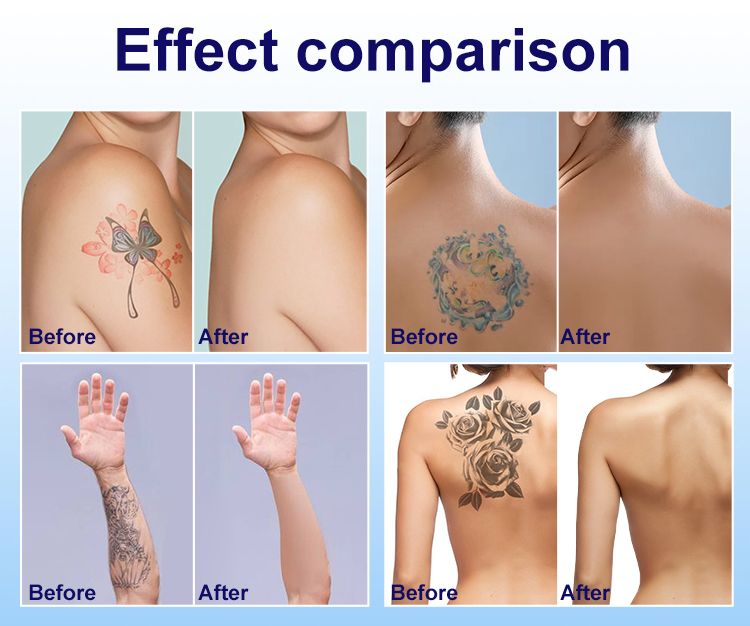 ND:YAG Laser Tattoo Removal Before and After