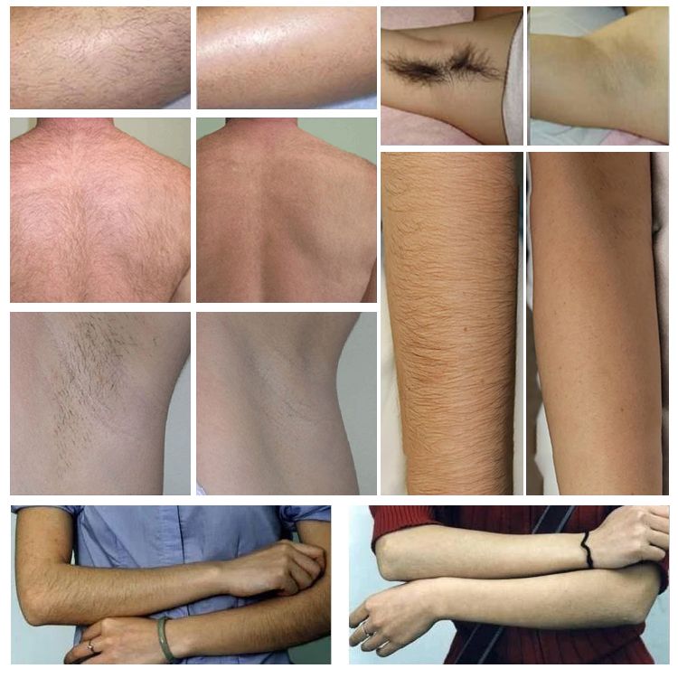 Before & After Diode Laser Hair Removal Therapy