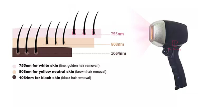 The effect of 755nm 808nm 1064nm on different skin colors