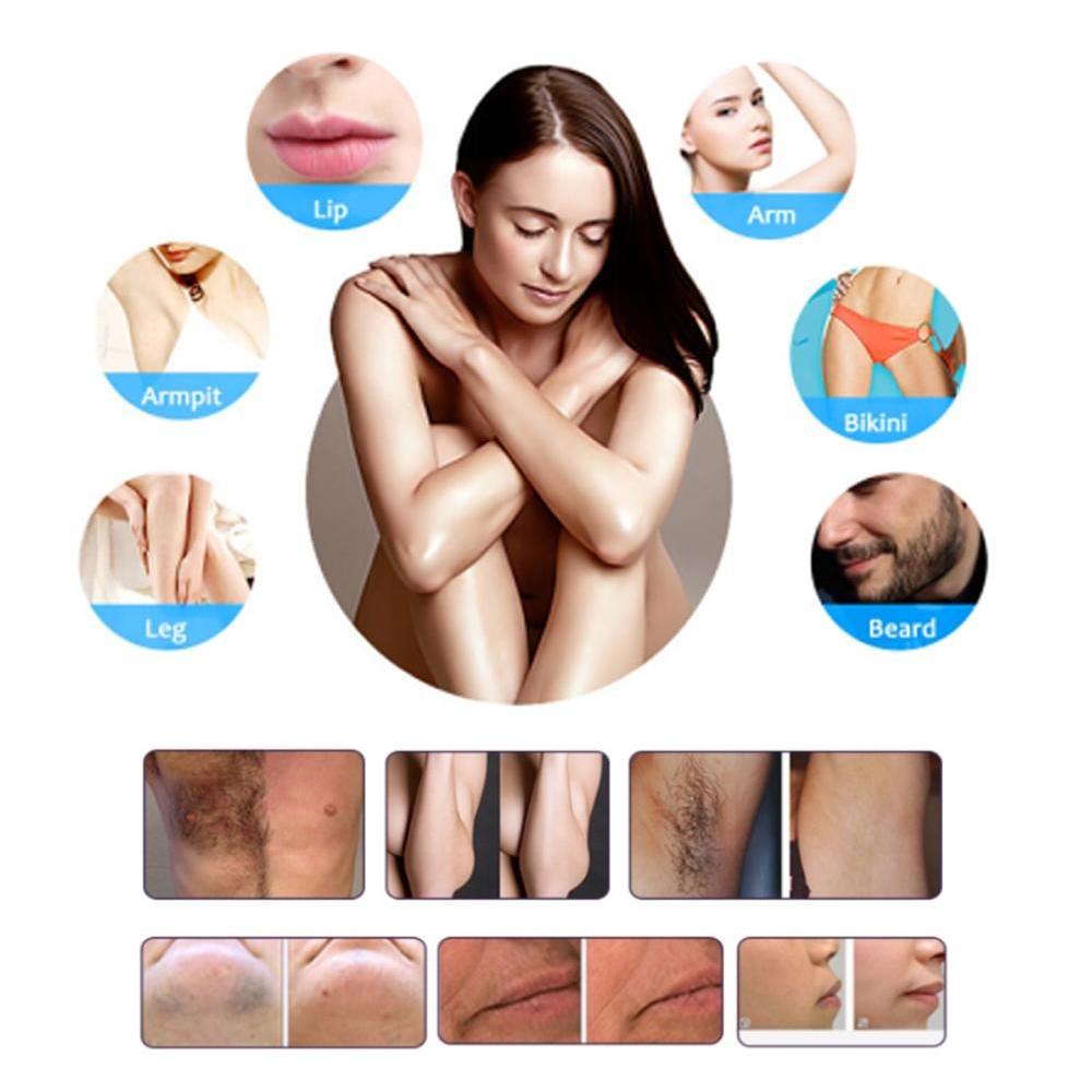 Diode Laser Hair Removal Before & After Result