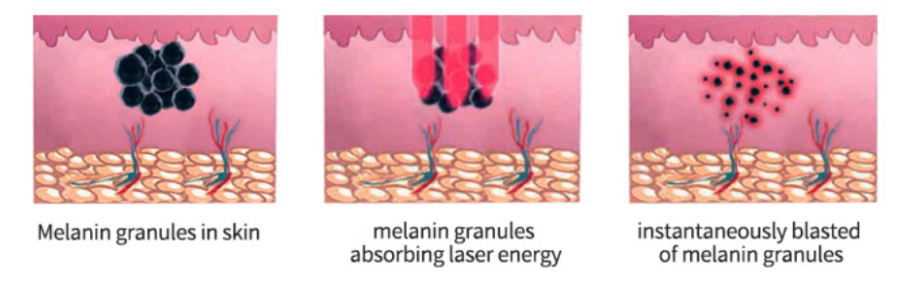 How does Fractional CO2 Laser work