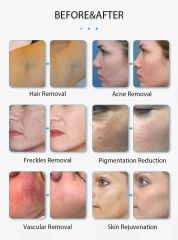 Portable Intense Pulsed Light IPL Machine