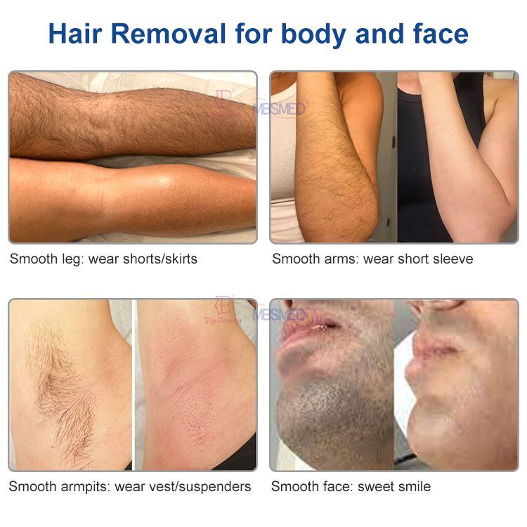 Portable 3 Wavelength Diode Laser Hair Removal Machine