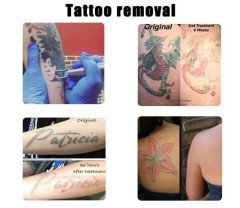 Portable Q Switch Nd Yag Laser Tattoo Removal Machine