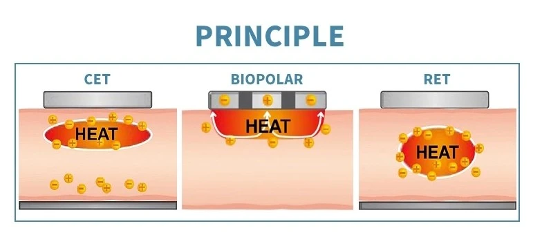 What is Tecar Therapy Tecar Principle
