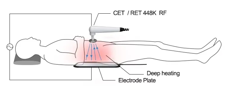 What is 448KHz Tecar Therapy