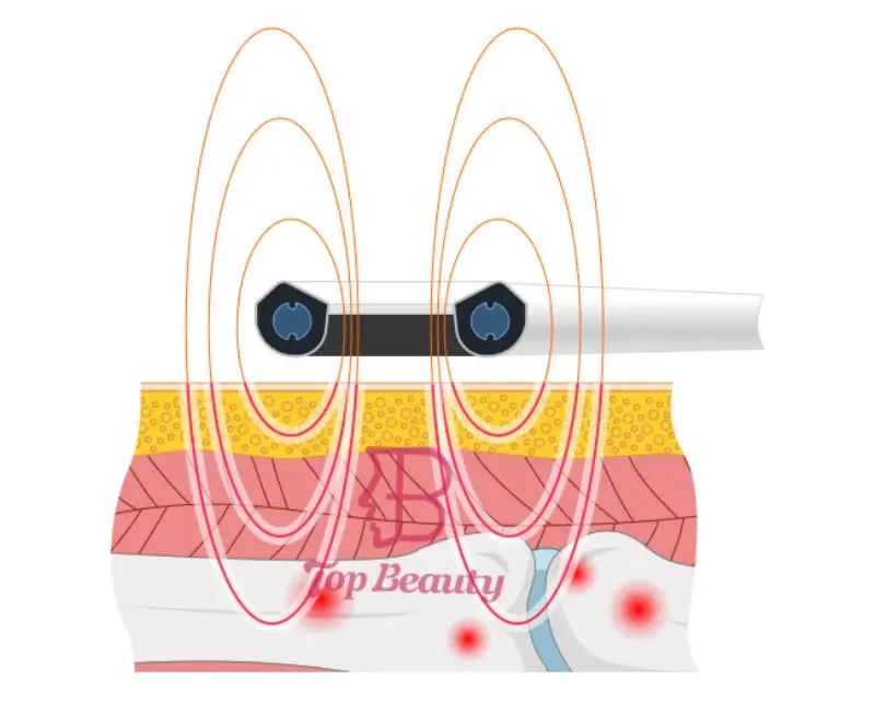 What is Magneto Therapy?