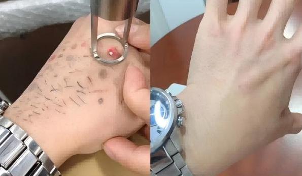 Fractional CO2 Laser Fast Recovery