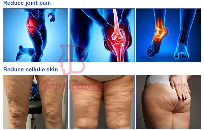 Pressotherapy for Muscles & Skin