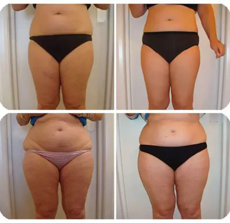 Pressotherapy for Slimming and Body Contouring