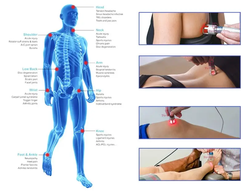 980nm Physical Laser Therapy Application
