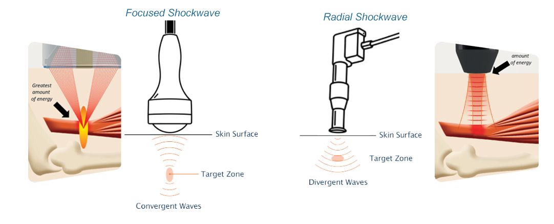 Focused Shockwave vs Radial Shockwave