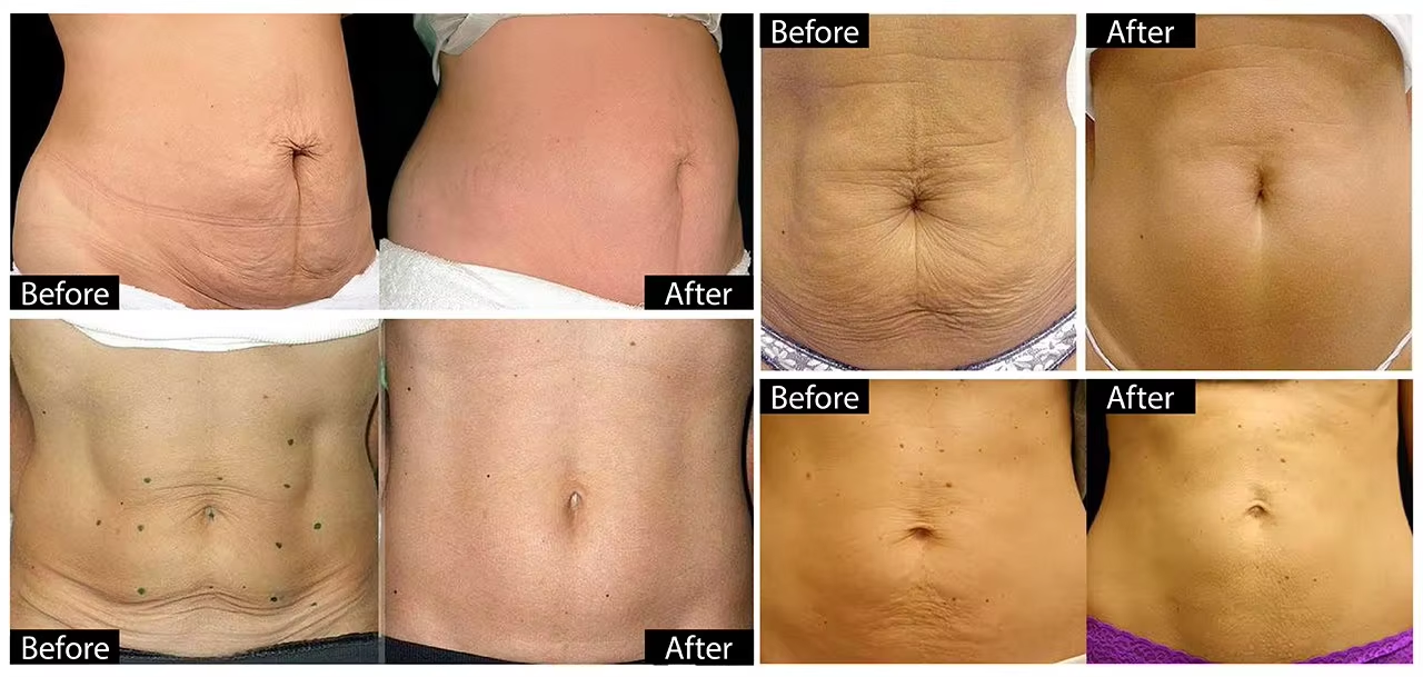Real HIFU Before and After Results for Body