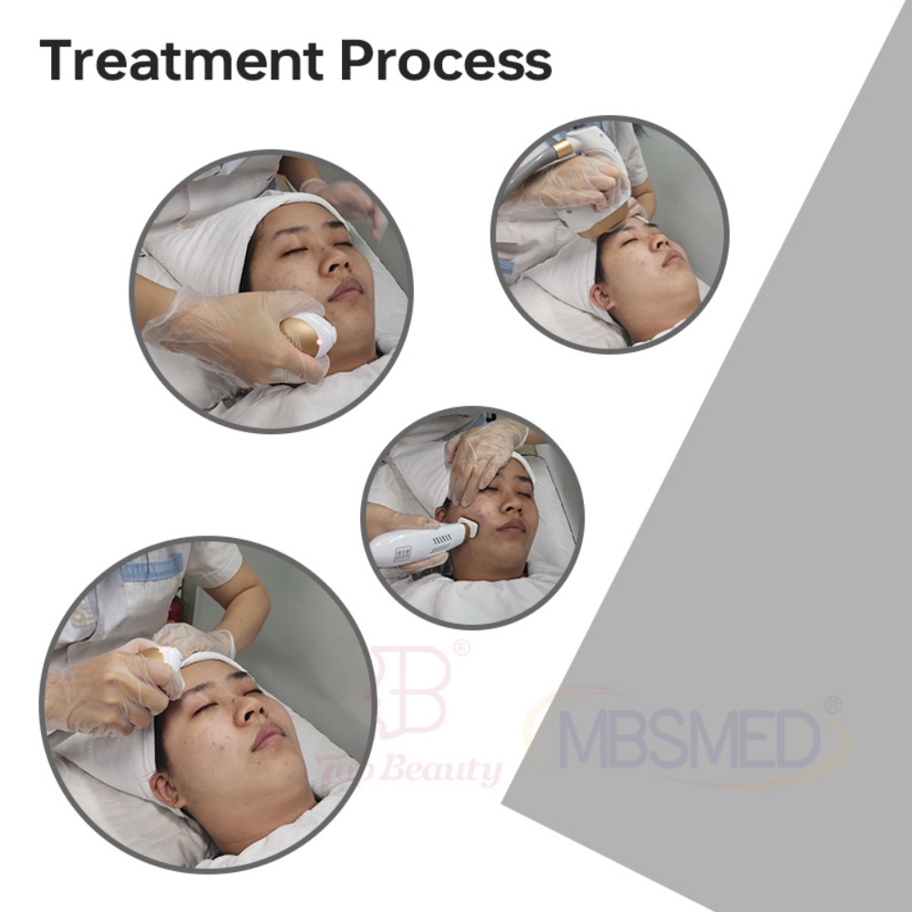 12D HIFU Machine Treatment Process